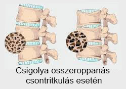 csigolya összeroppanás csontritkulás esetén